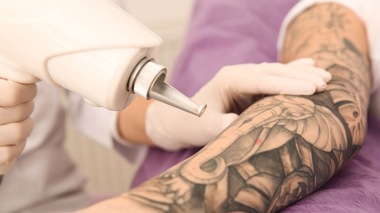 Guía completa sobre la eliminación de tatuajes con láser