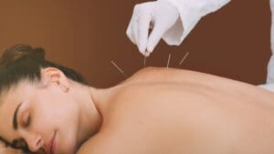 Mujer relajándose durante una sesión de acupuntura con agujas aplicadas en la espalda en un entorno de bienestar.