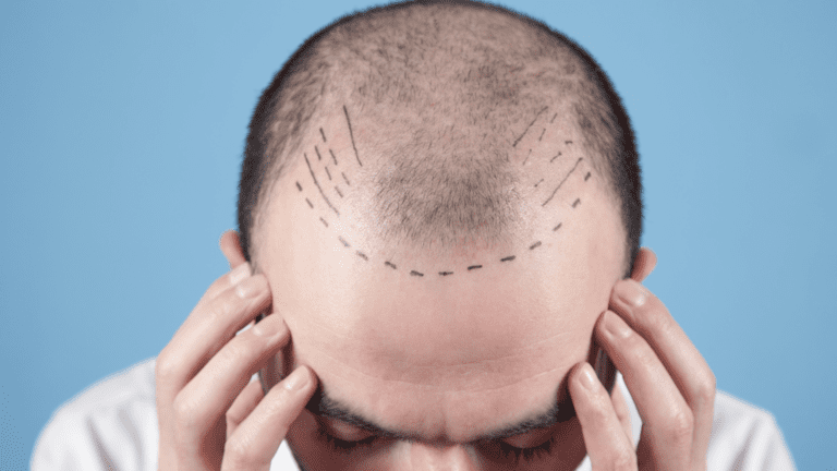 ¿Qué es la micropigmentación capilar y por qué se elige cada vez más?