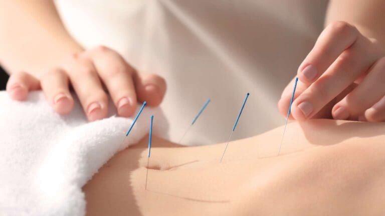 Mujer recibiendo acupuntura como parte de terapias alternativas para acompañar cambios hormonales.