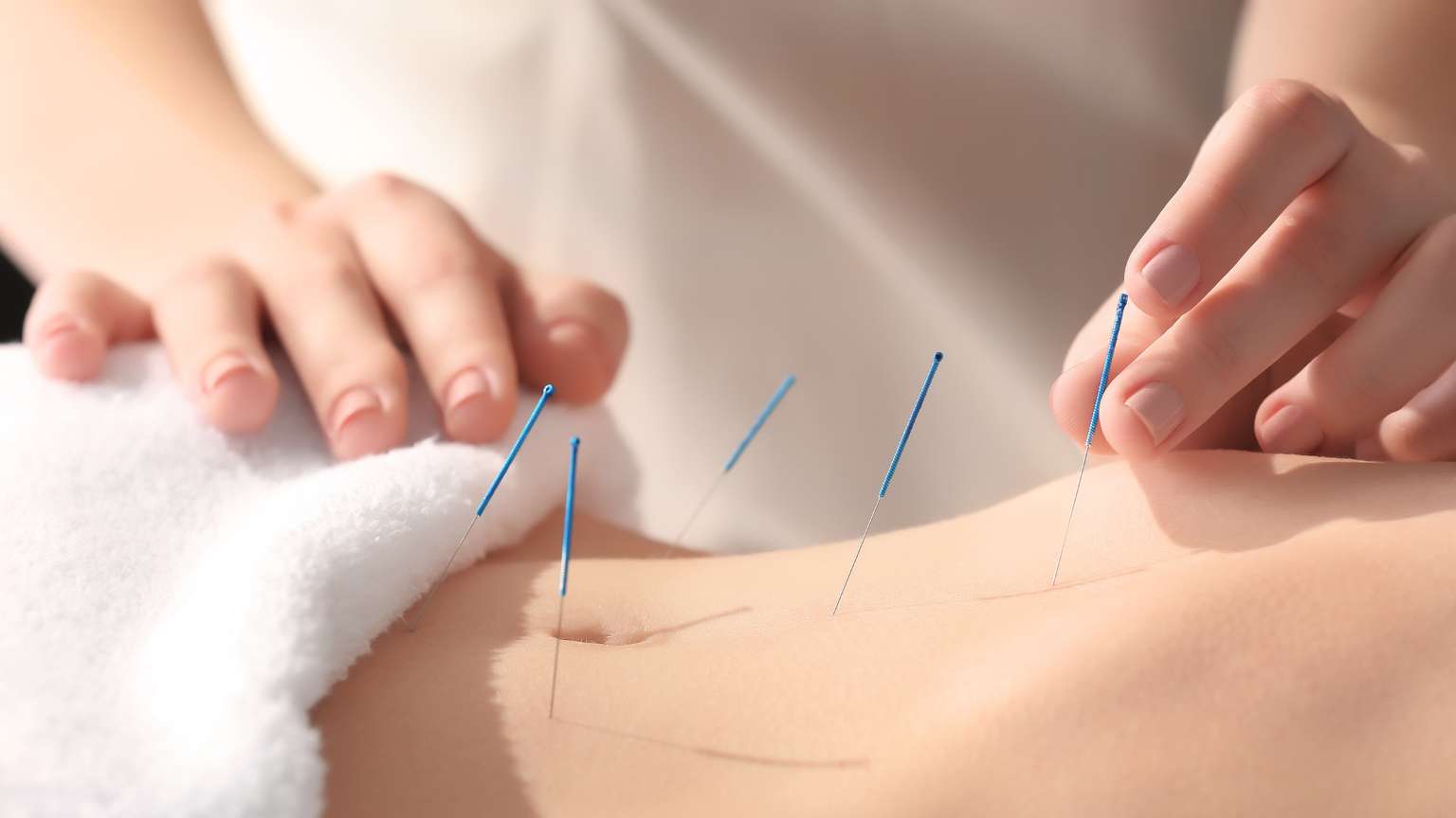 Mujer recibiendo acupuntura como parte de terapias alternativas para acompañar cambios hormonales.