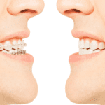 Tipos de ortodoncia utilizados para corregir dientes torcidos o apiñamiento dental