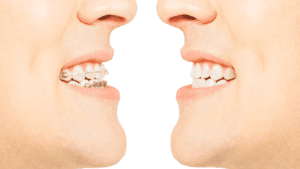 Tipos de ortodoncia utilizados para corregir dientes torcidos o apiñamiento dental