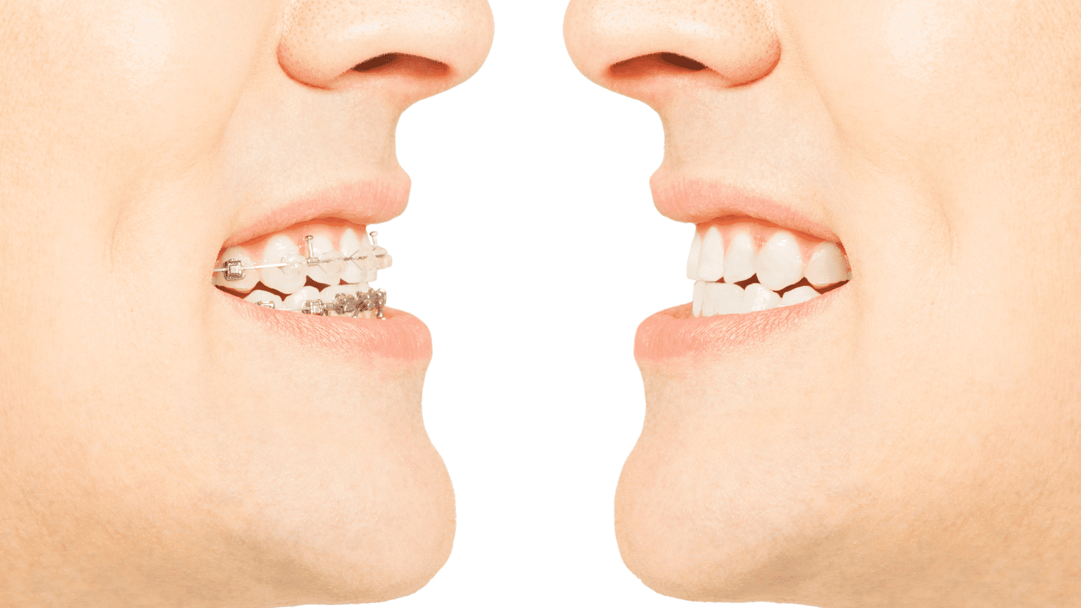 Tipos de ortodoncia utilizados para corregir dientes torcidos o apiñamiento dental