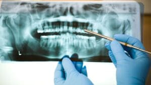 Dentista mostrando radiografía a paciente adulto como parte del diagnóstico previo al tratamiento de endodoncia en clínica dental profesional