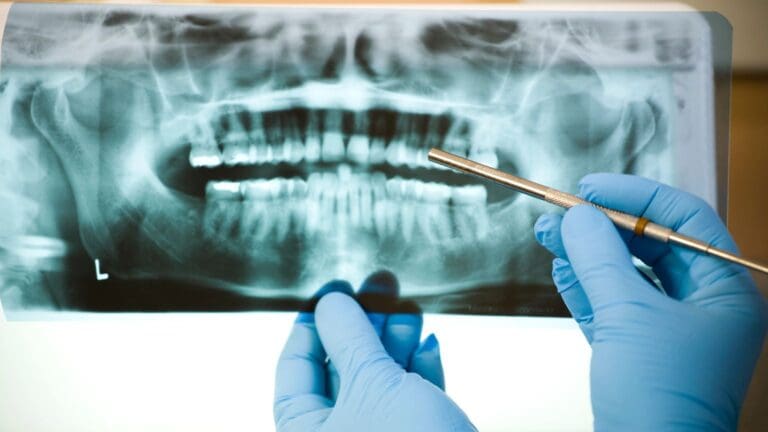 Dentista mostrando radiografía a paciente adulto como parte del diagnóstico previo al tratamiento de endodoncia en clínica dental profesional