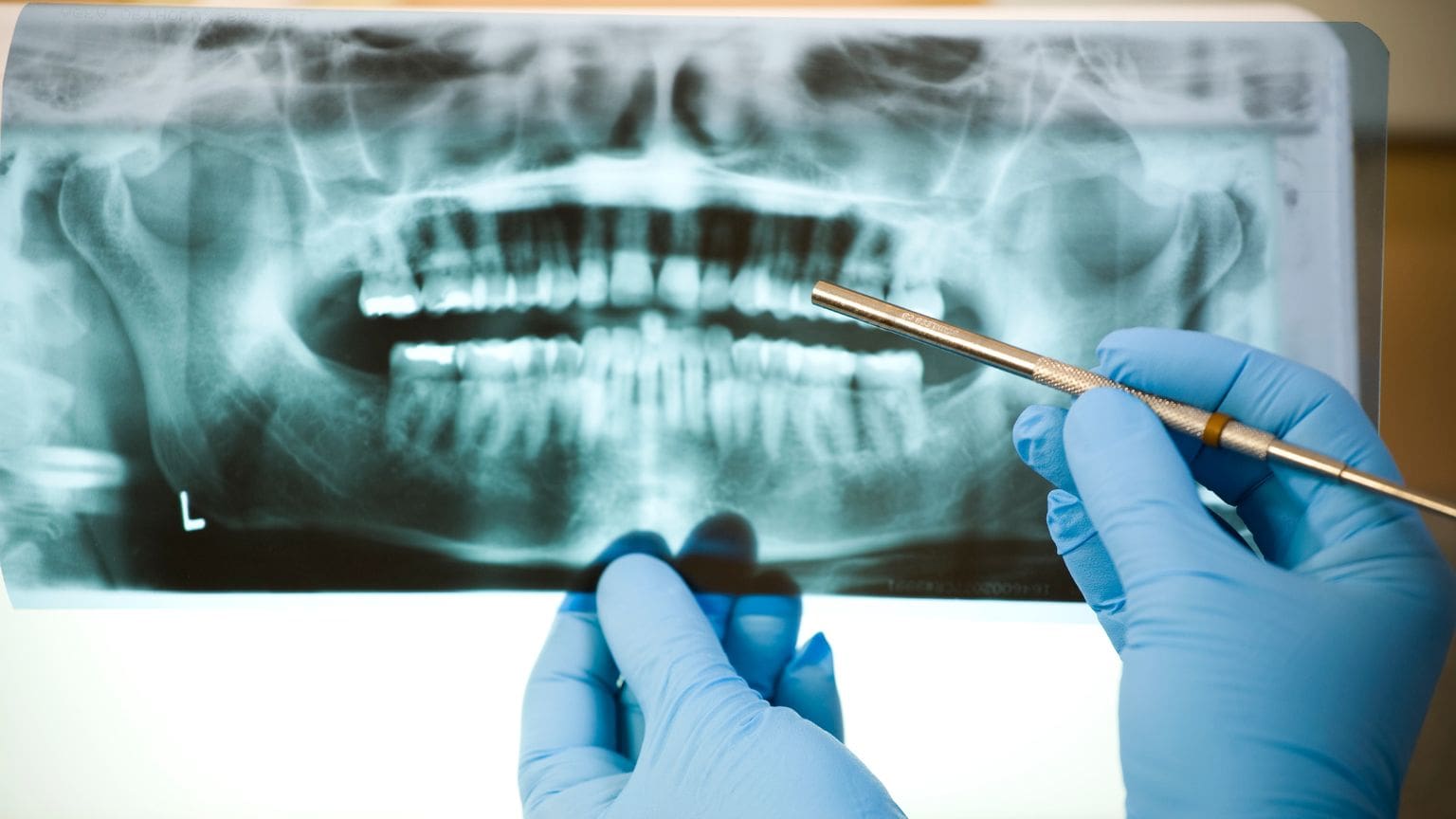 Dentista mostrando radiografía a paciente adulto como parte del diagnóstico previo al tratamiento de endodoncia en clínica dental profesional