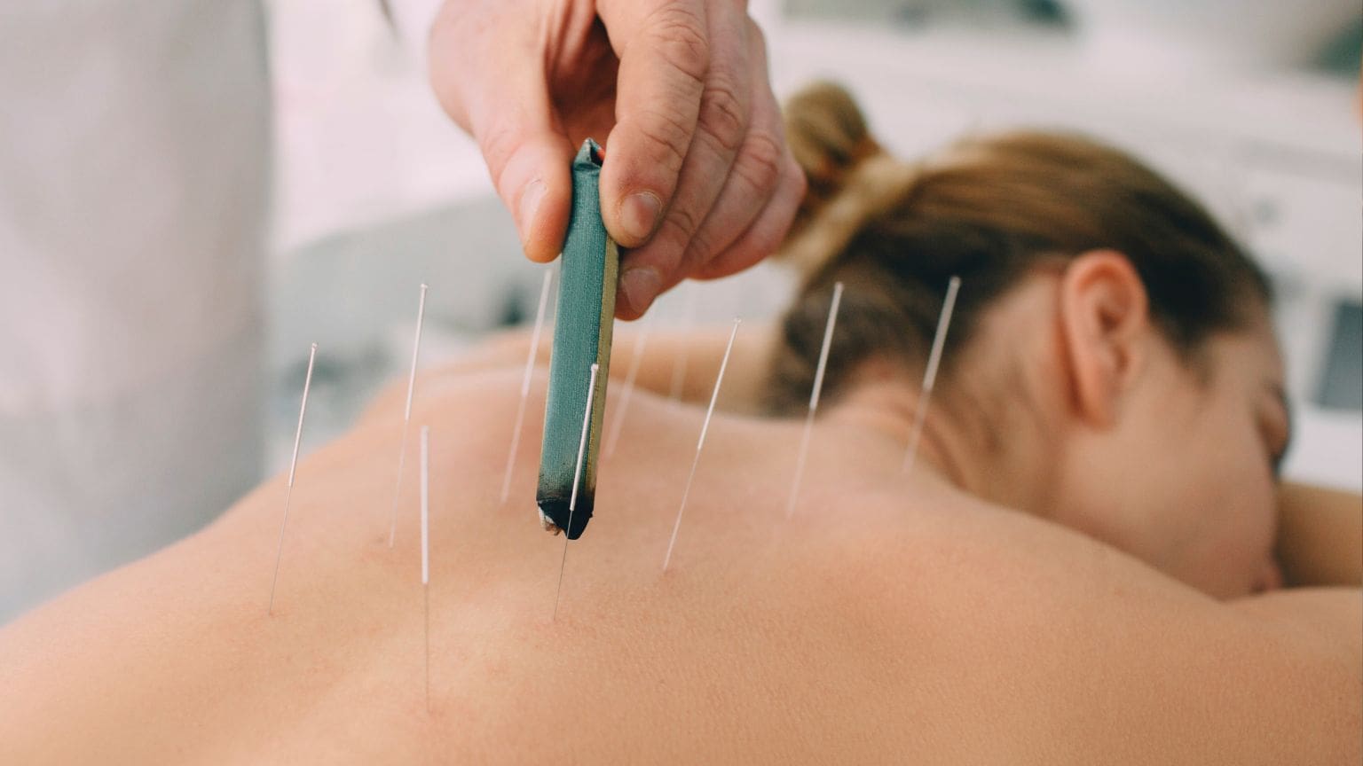 Sesión de acupuntura para el alivio del dolor crónico en un entorno terapéutico profesional y relajante.