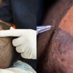 Comparativa entre micropigmentación capilar e injerto capilar como solución estética para la pérdida de densidad capilar sin cirugía