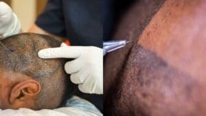 Comparativa entre micropigmentación capilar e injerto capilar como solución estética para la pérdida de densidad capilar sin cirugía