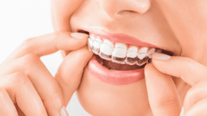 Ortodoncia invisible en adultos ventajas reales frente a los brackets