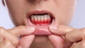 Paciente en revisión dental por sangrado de encías para mejorar su salud bucodental